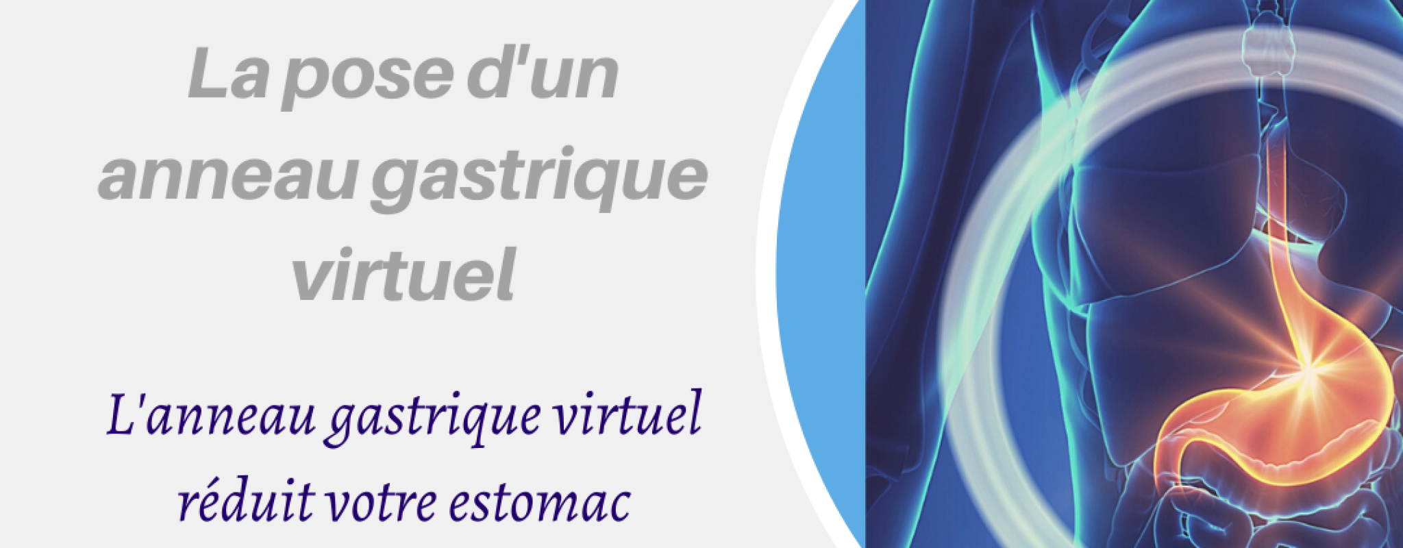 anneau gastrique virtuel
